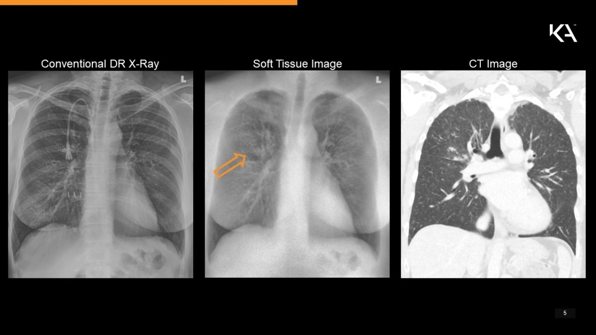 KA Imaging X ray in ICU