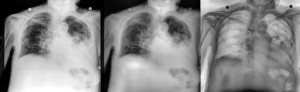 X-ray for Pneumothorax Diagnosis