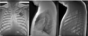 A reveal 35c x ray image showing cardiovascular disease