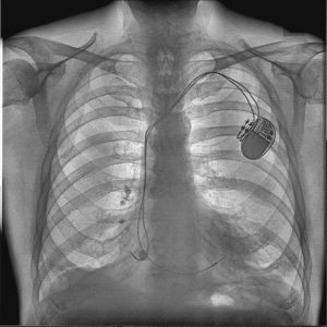 a high density x ray image with reveal 35c for detecting pulmonary lesions