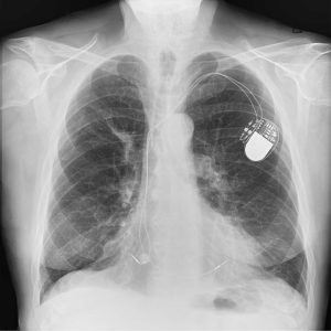 traditional DR x ray image with reveal 35c to detect lung lesions