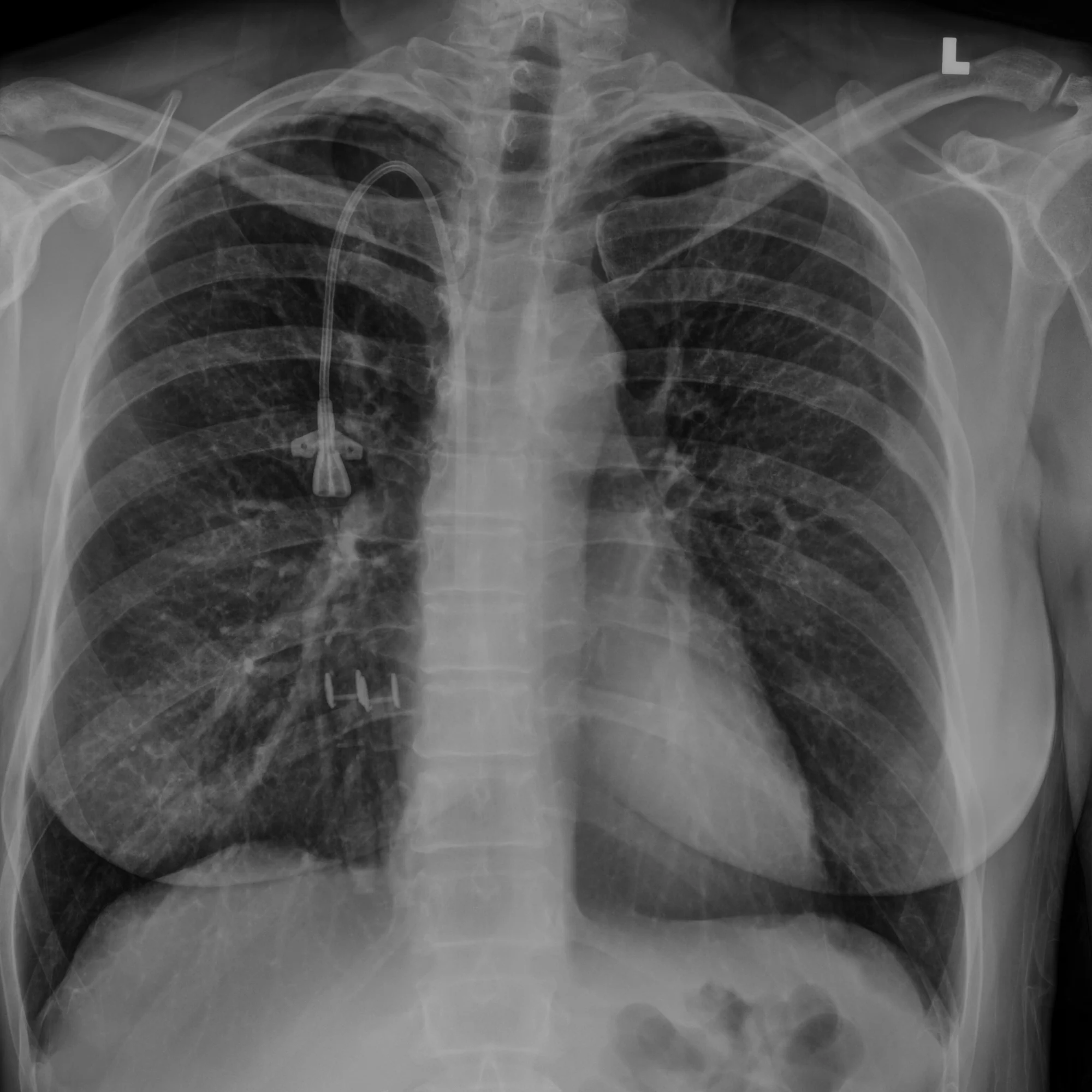 pneumonia-dr-patient-23