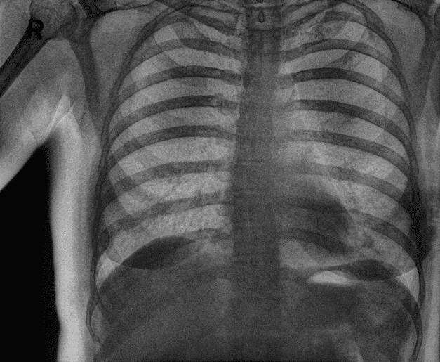 cxr for pneumonia rib bone spectral dr imaging