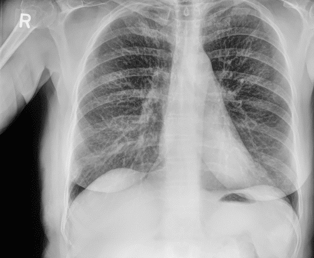 cxr for pneumonia combined imaging of bone and soft tissue