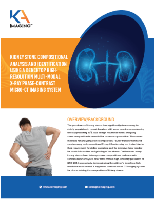 Exec Summary kidney stones