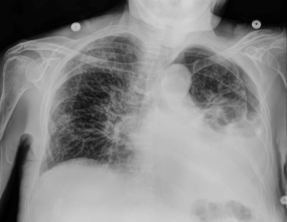 pneumothorax dr