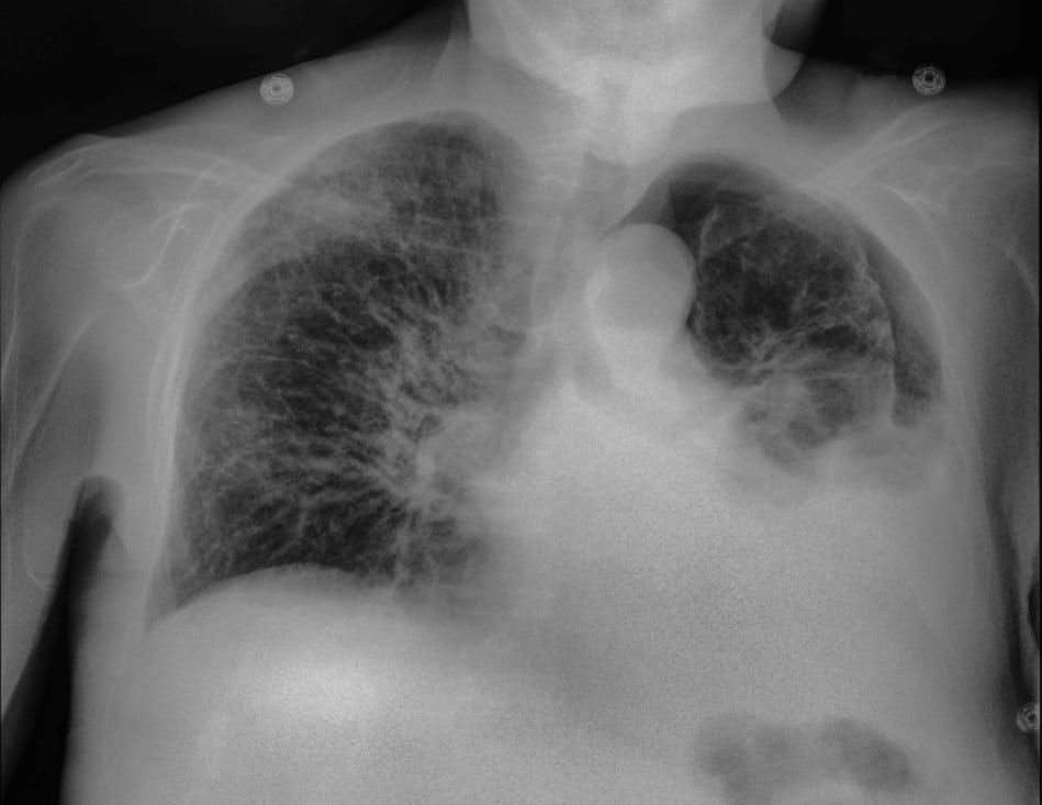 pneumothorax soft tissue